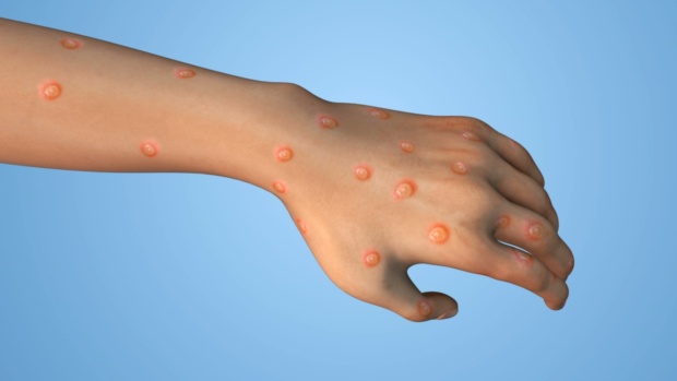 V Furlaniji - Julijski krajini sedem okuženih z virusom opičjih koz