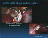 Pri peritonealni  endometriozi kaže posnetek cisto na jajčniku (zgornja slika) in zdrav jajčnik ter rodila (spodaj desno)  Foto: Ginekol. Klinika Ukc Ljubljana